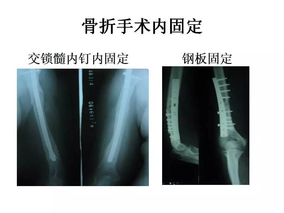 凹頭彈 视频截图